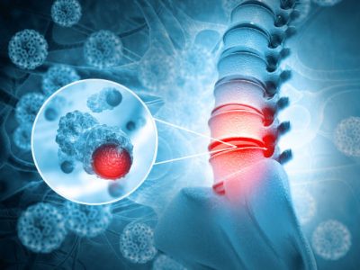 Spine cancer or spinal tumor disease.3d illustration